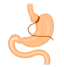 Adjustable Gastric Band (AGB)