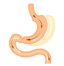 Verticle Sleeve Gastrectomy (VSG)