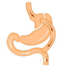 Roux-en-Y Gastric Bypass (RYGB)