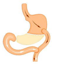 Biliopancreatic Diversion (BPD)