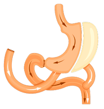 Biliopancreatic Diversion With a Duodenal Siwtch (BPD-DS)