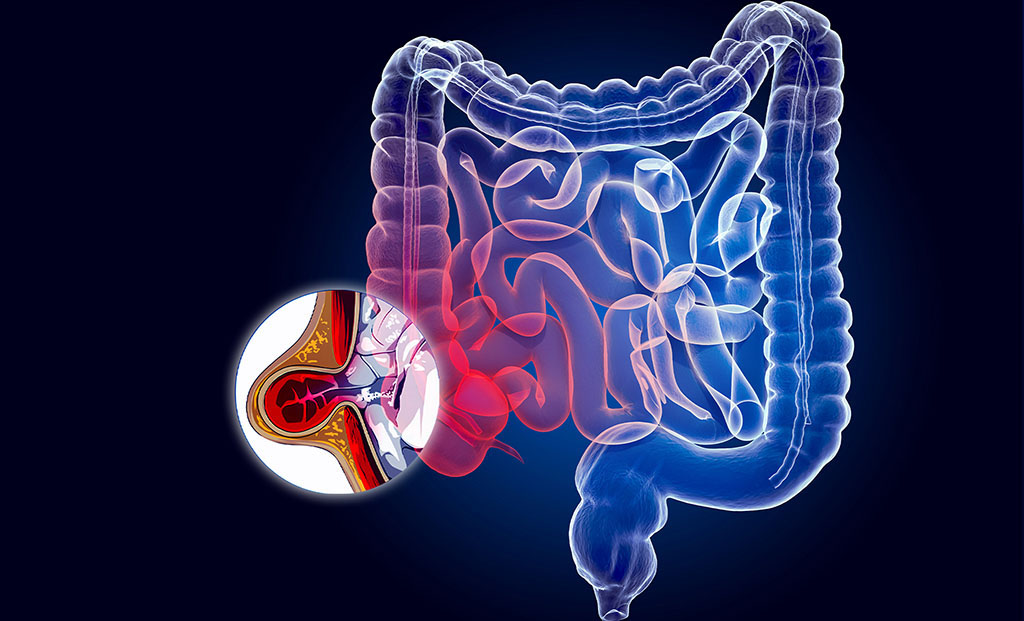 Specialise Services - Hernia